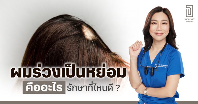 ผมร่วงเป็นหย่อม คืออะไร รักษาที่ไหนดี ?