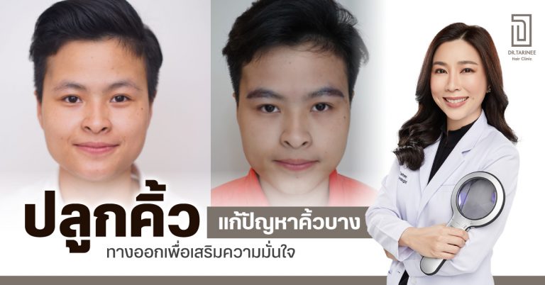 ปลูกคิ้ว แก้ปัญหาคิ้วบาง ทางออกเพื่อเสริมความมั่นใจ