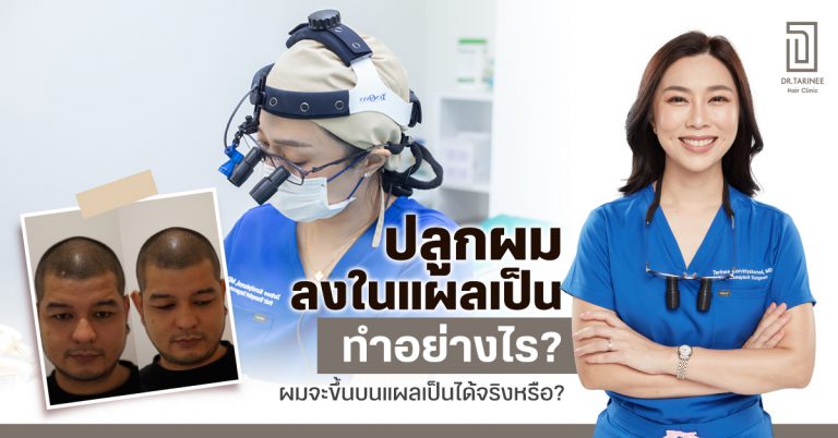 ปลูกผมลงในแผลเป็นทำอย่างไร? ผมจะขึ้นบนแผลเป็นได้จริงหรือ?