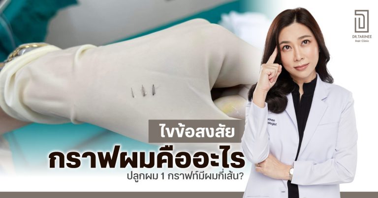 ไขข้อสงสัย กราฟผมคืออะไร ปลูกผม 1 กราฟท์มีผมกี่เส้น?