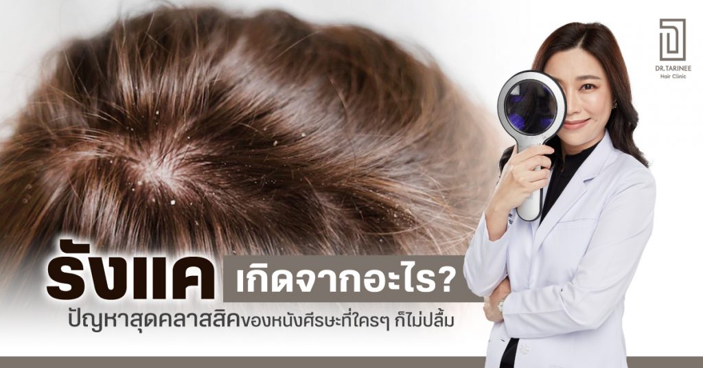 รังแคเกิดจากอะไร