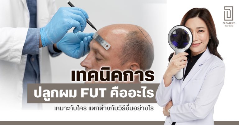 เทคนิคการปลูกผม FUT คืออะไร เหมาะกับใคร แตกต่างกับวิธีอื่นอย่างไร