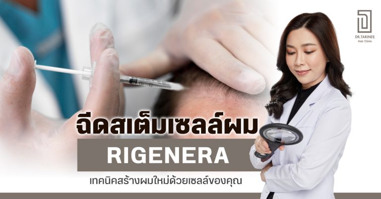 ฉีดสเต็มเซลล์ผม Rigenera เทคนิคสร้างผมใหม่ด้วยเซลล์ของคุณ