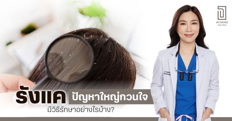 “รังแค” ปัญหาใหญ่กวนใจ มีวิธีรักษาอย่างไรบ้าง?