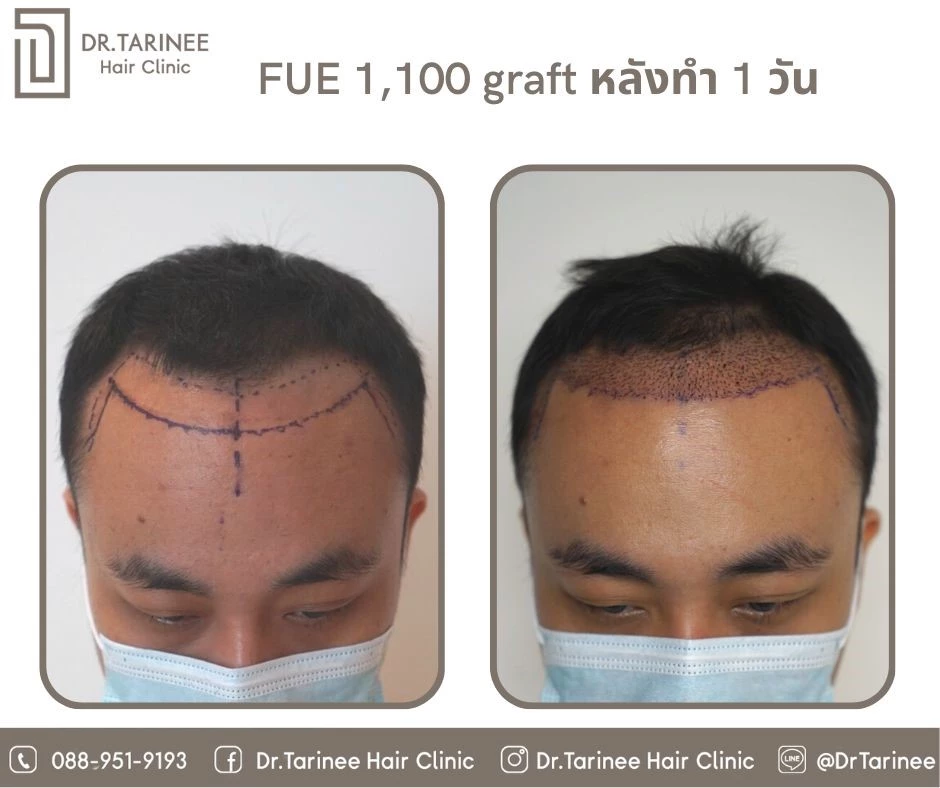 รีวิวปลูกผมแบบ FUE