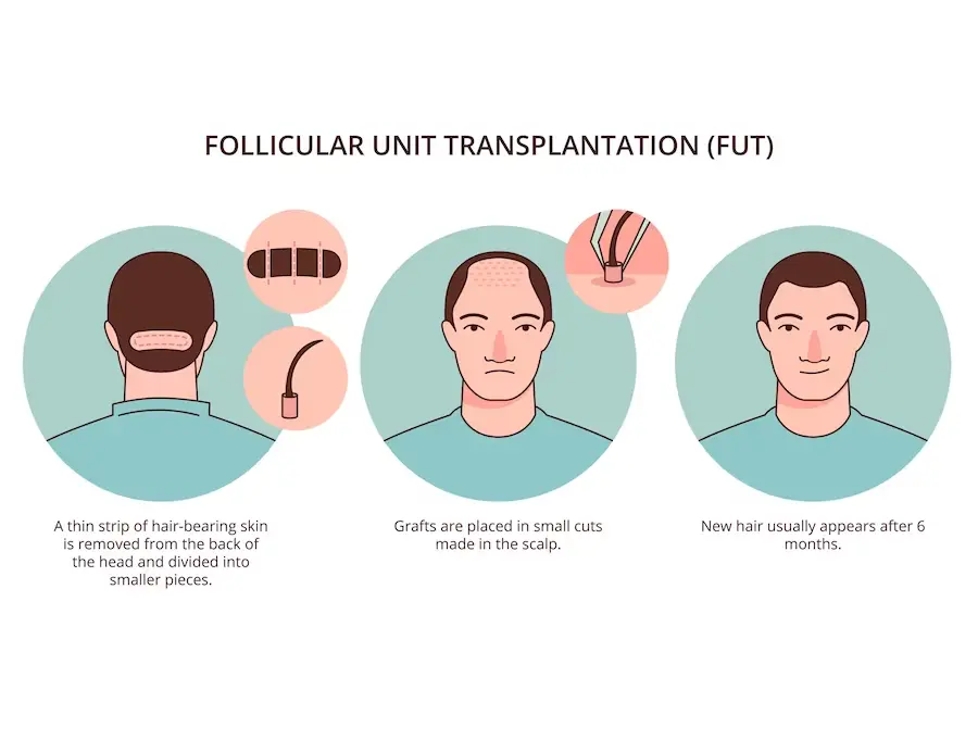 รีวิวปลูกผมแบบ Strip FUT