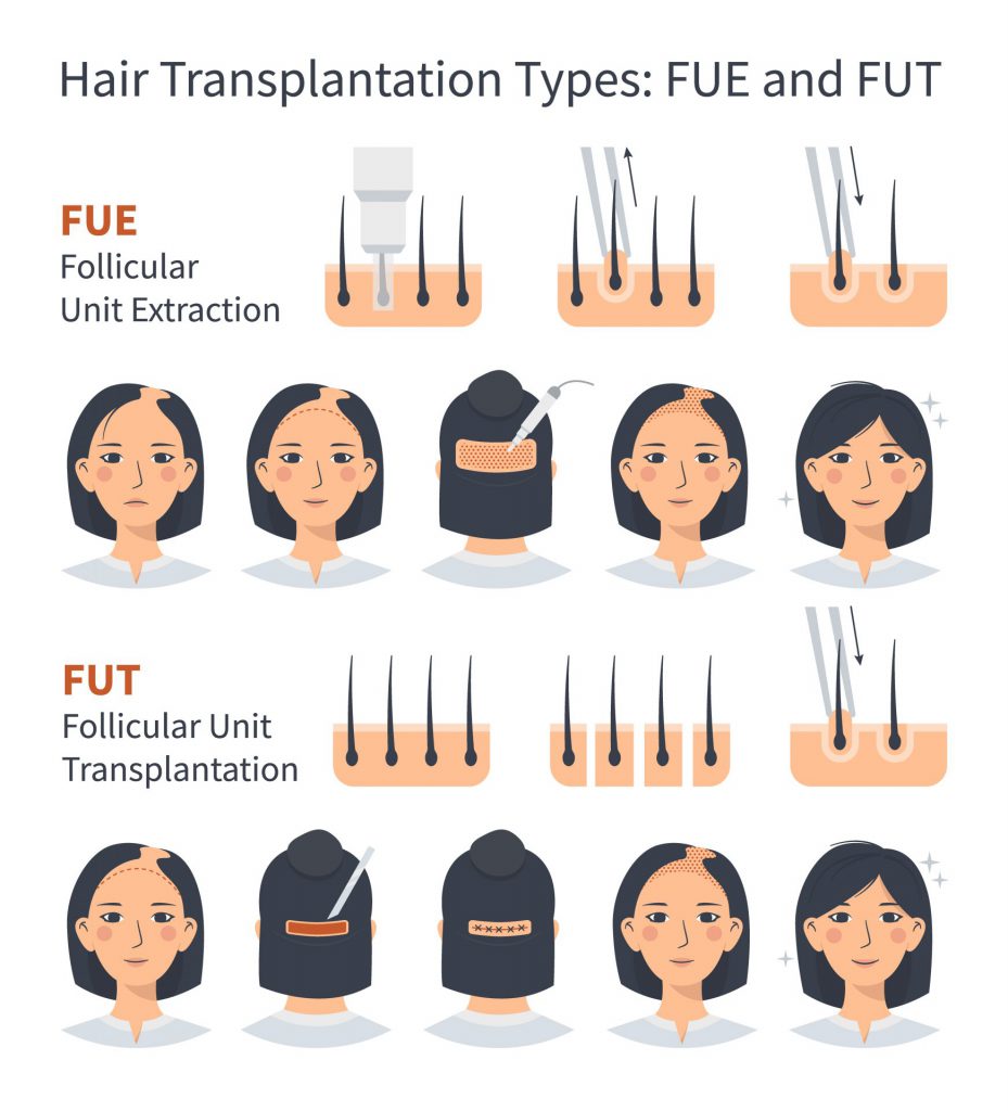 ความแตกต่างระหว่างปลูกผม FUE และ FUT