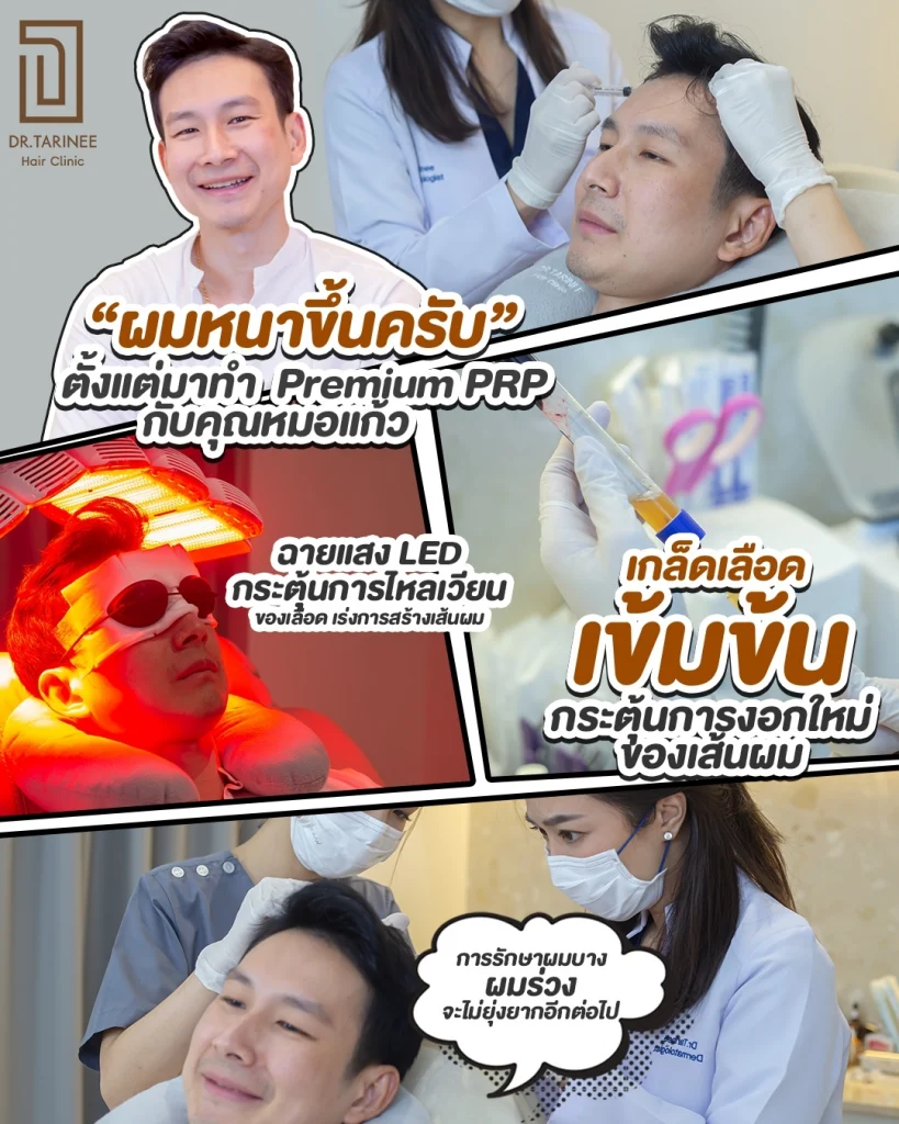 ขั้นตอนการรักษาด้วยการฉีด PRP 