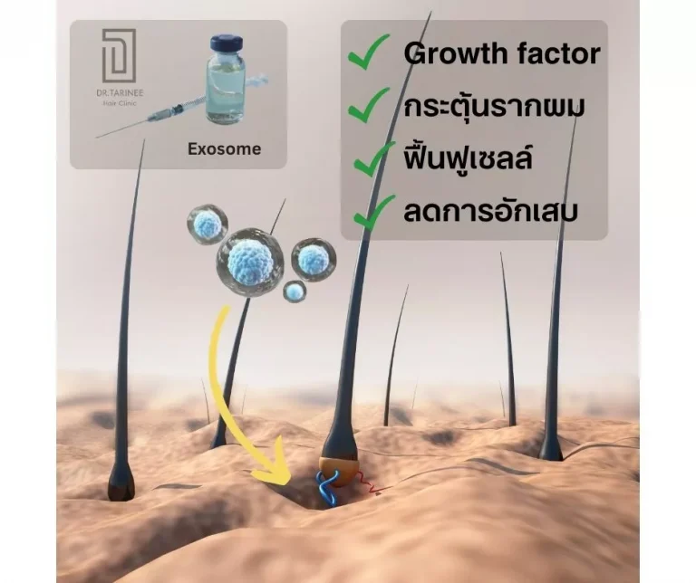 ฉีดเอ็กโซโซม (Exosome) แก้ปัญหาผมร่วง ผมบาง โดยไม่ต้องผ่าตัด